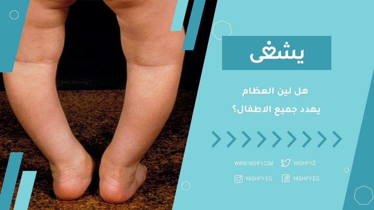 هل لين العظام يهدد جميع الاطفال؟