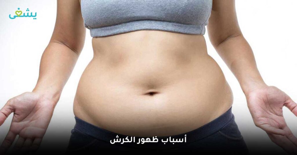 أسباب-ظهور-الكرش