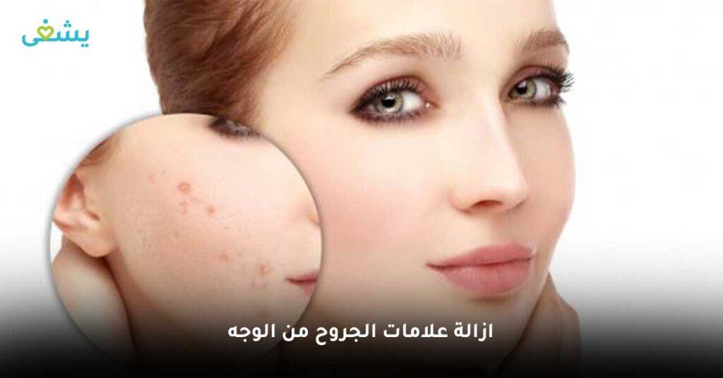 ازالة-علامات-الجروح-من-الوجه