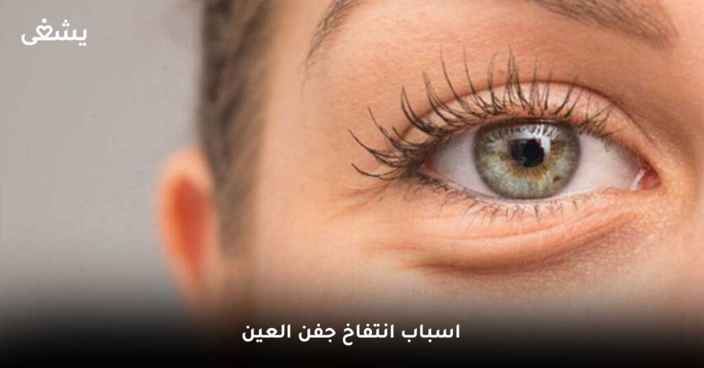 اسباب-انتفاخ-جفن-العين