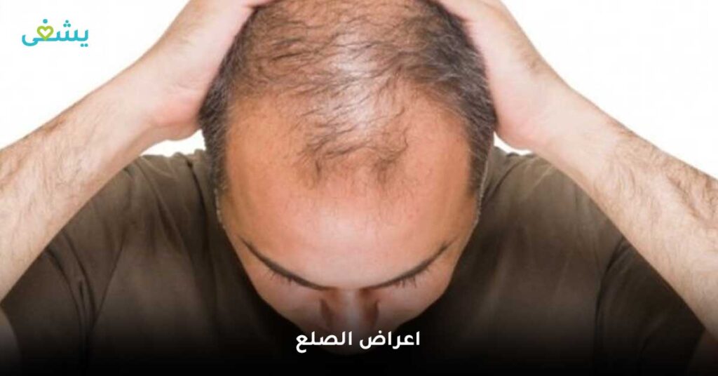 اعراض-الصلع