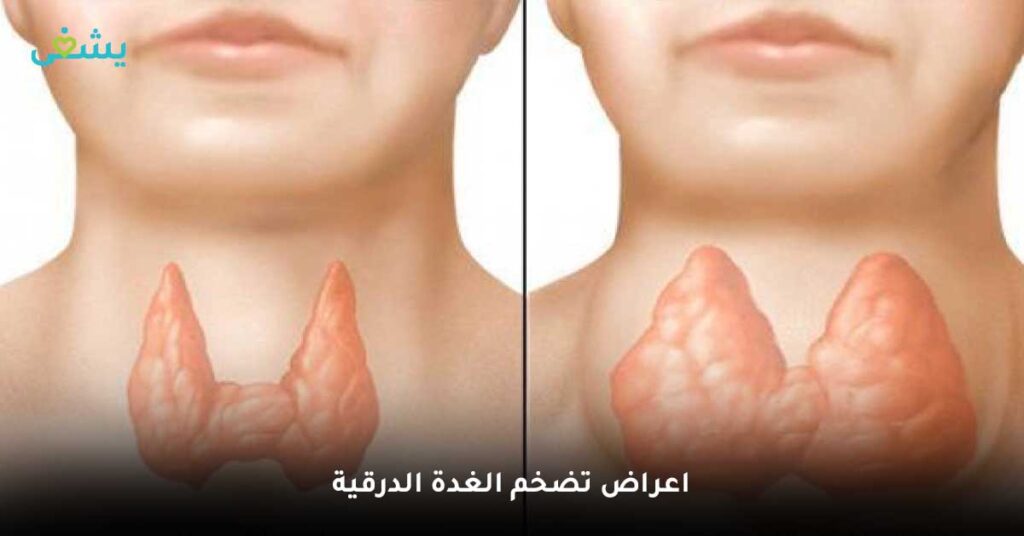 اعراض-تضخم-الغدة-الدرقية