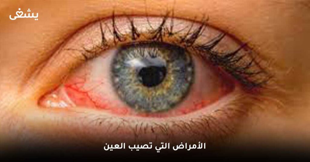 الأمراض-التي-تصيب-العين