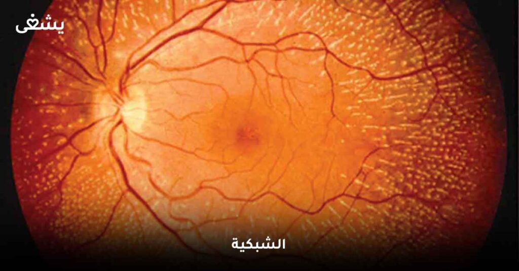 الشبكية