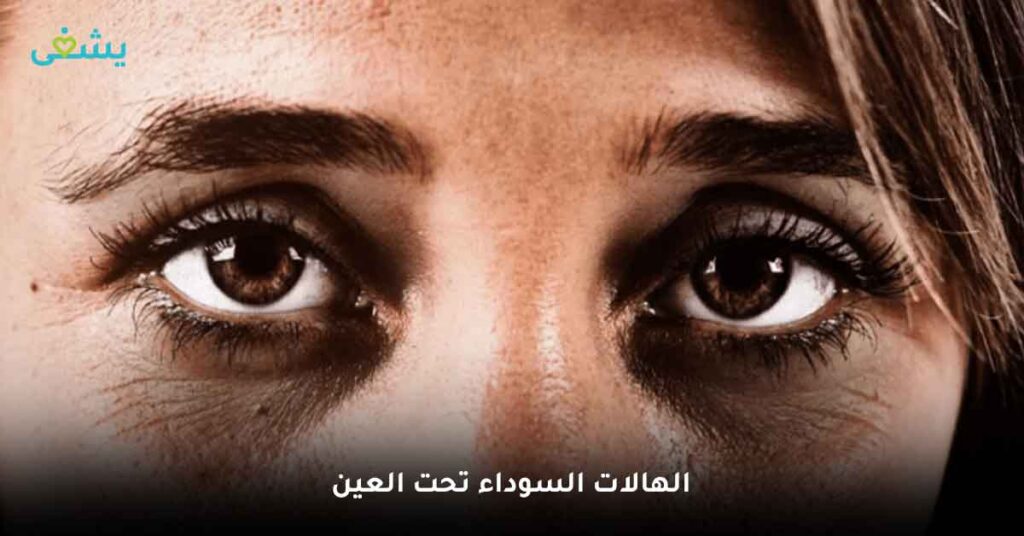الهالات-السوداء-تحت-العين