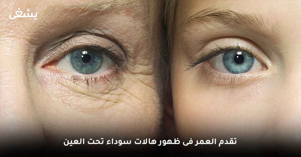 تقدم-العمر-فى-ظهور-هالات-سوداء-تحت-العين