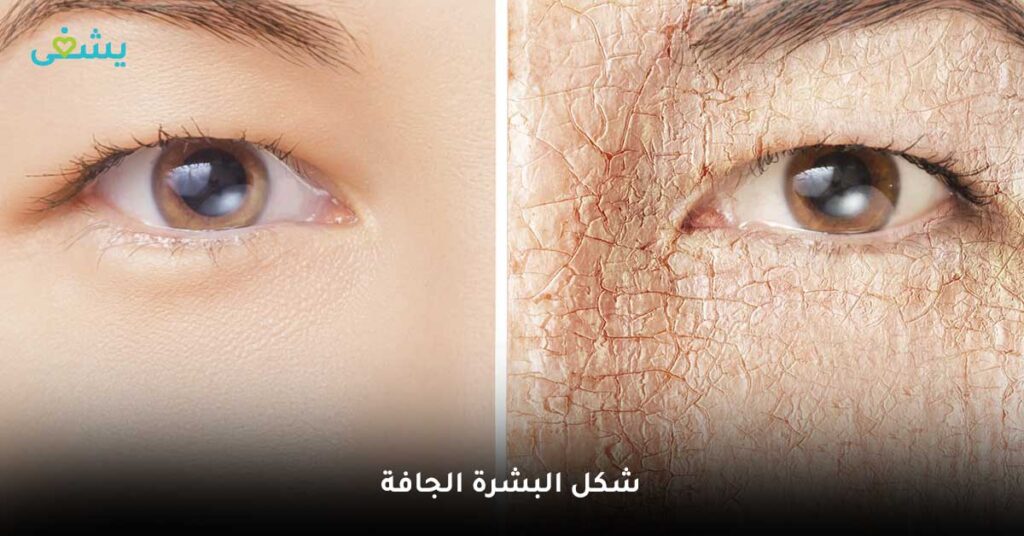 شكل-البشرة-الجافة