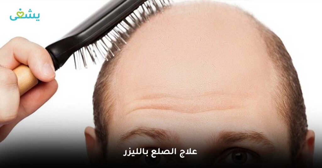 علاج-الصلع-بالليزر