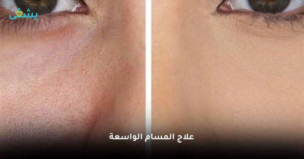 علاج-المسام-الواسعة