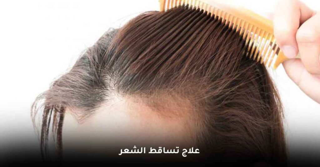 علاج-تساقط-الشعر