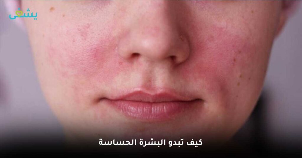 كيف-تبدو-البشرة-الحساسة