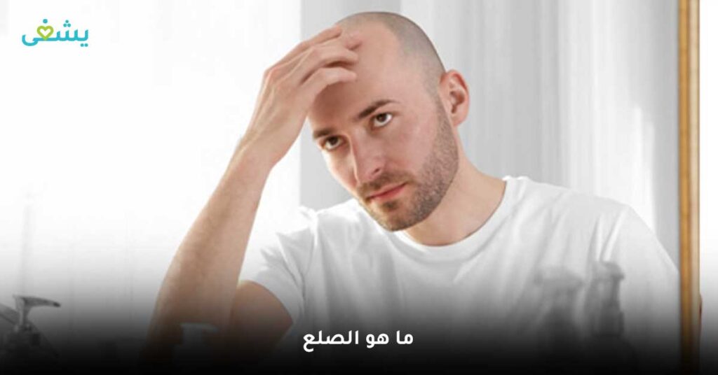 ما-هو-الصلع