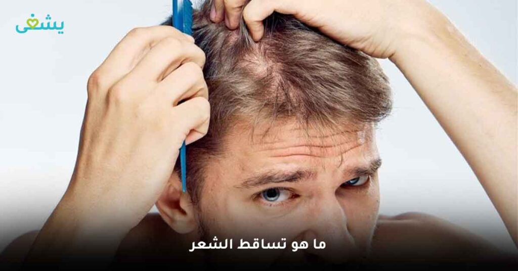 ما-هو-تساقط-الشعر