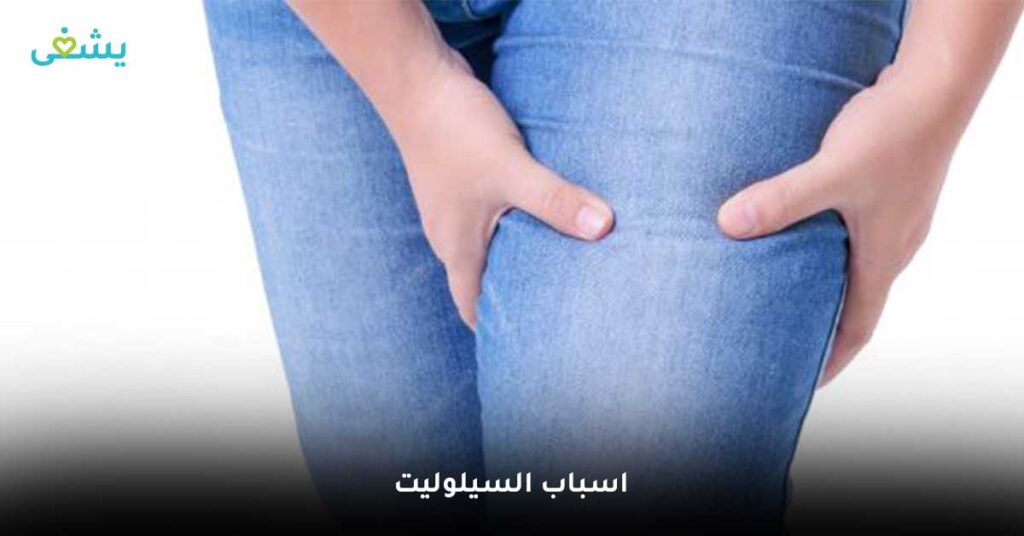 اسباب-السيلوليت