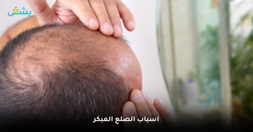 اسباب-الصلع-المبكر