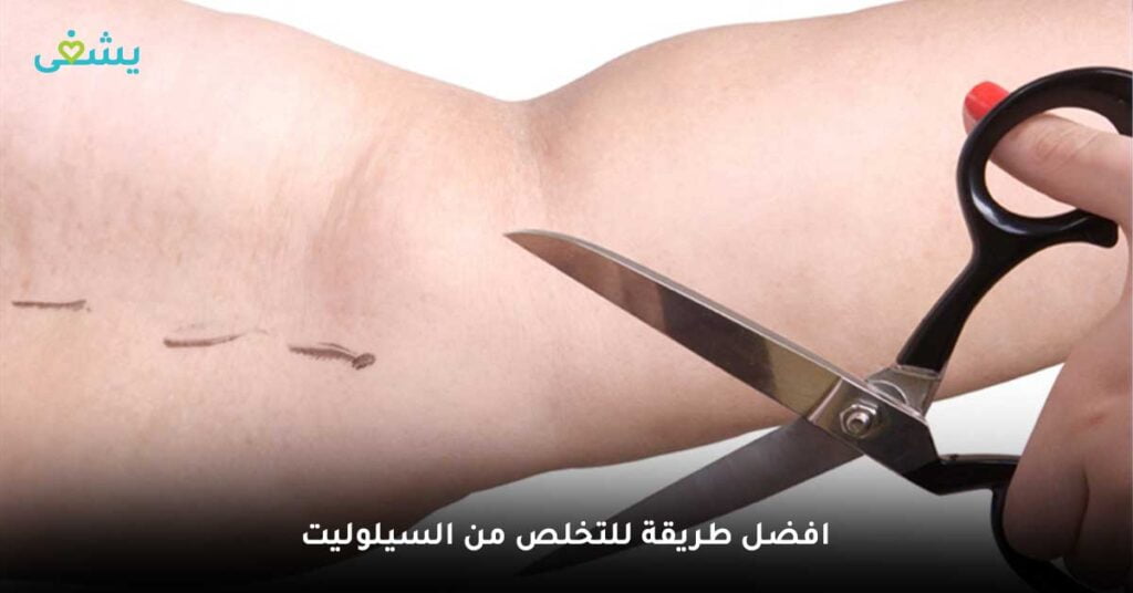 التخلص-من-السيلوليت