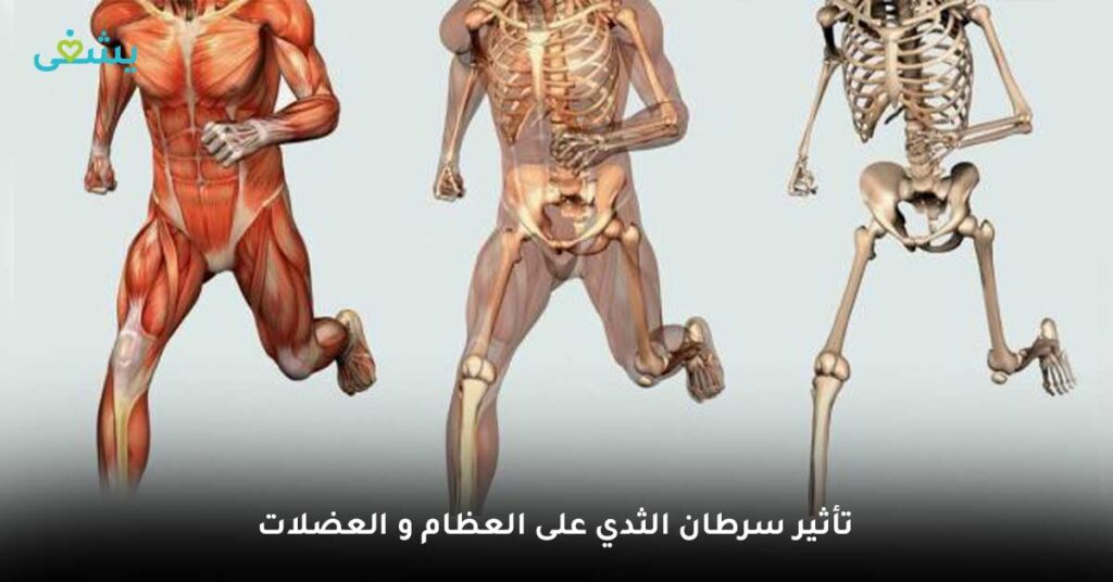 تأثير-سرطان-الثدي-على-العظام-و-العضلات