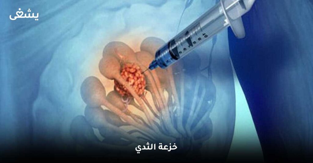 خزعة-الثدي