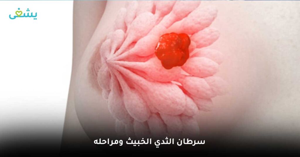 سرطان-الثدي-الخبيث-ومراحله