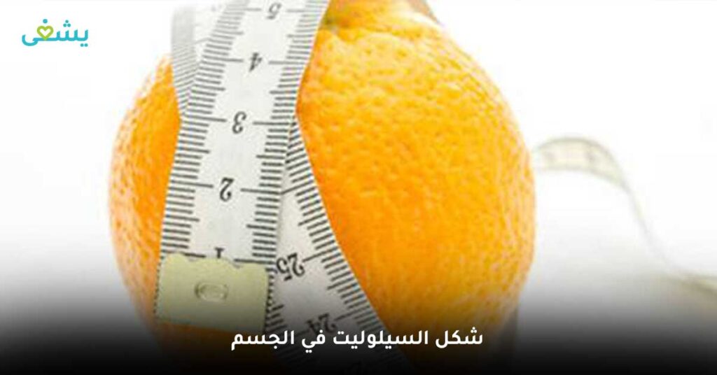 شكل-السيلوليت-في-الجسم