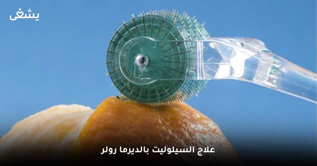 علاج-السيلوليت-بالديرما-رولر
