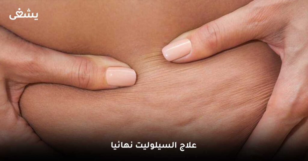 علاج-السيلوليت-نهائيا