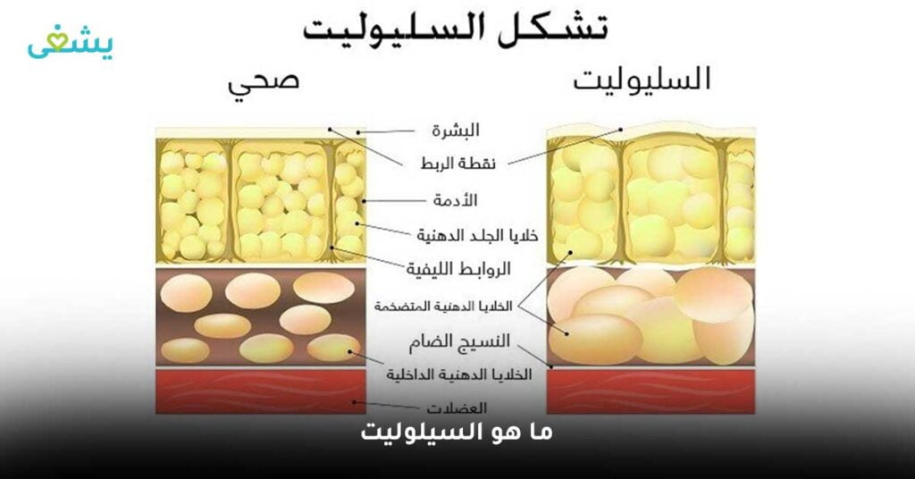 ما-هو-السيلوليت