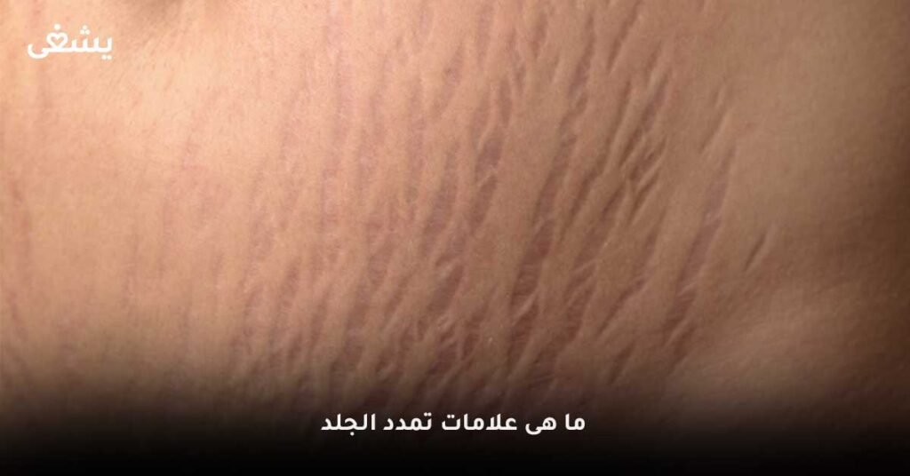 ما-هى-علامات-تمدد-الجلد