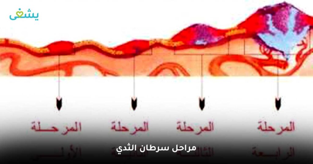 مراحل-سرطان-الثدي