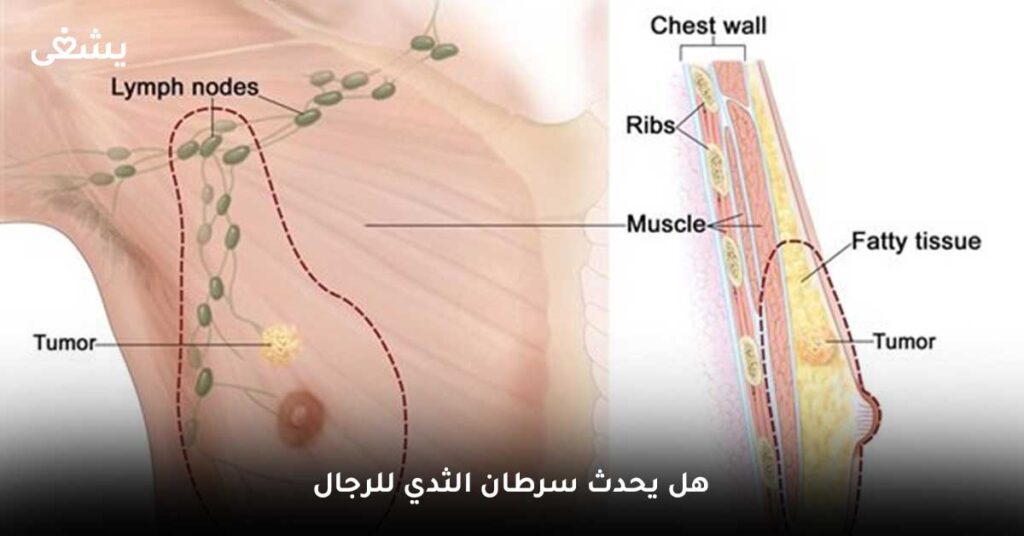 هل-يحدث-سرطان-الثدي-للرجال