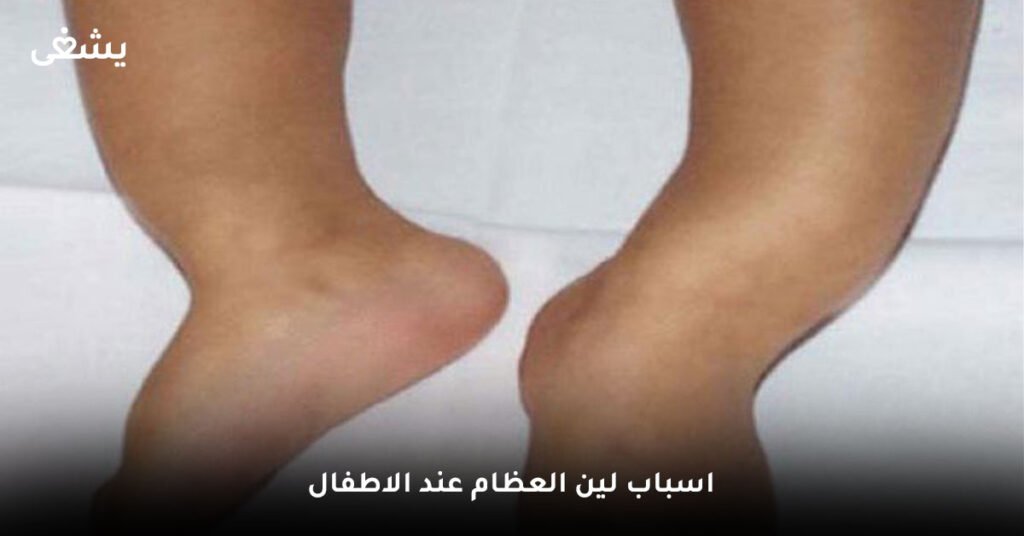 اسباب لين العظام عند الاطفال