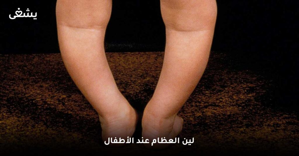 لين العظام عند الأطفال