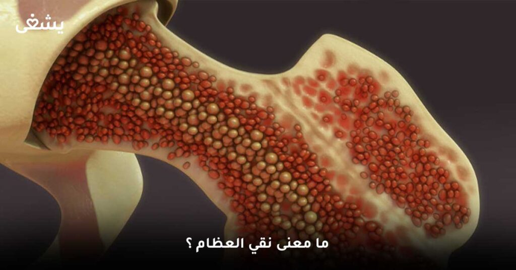ما-معنى-نقي-العظام-؟