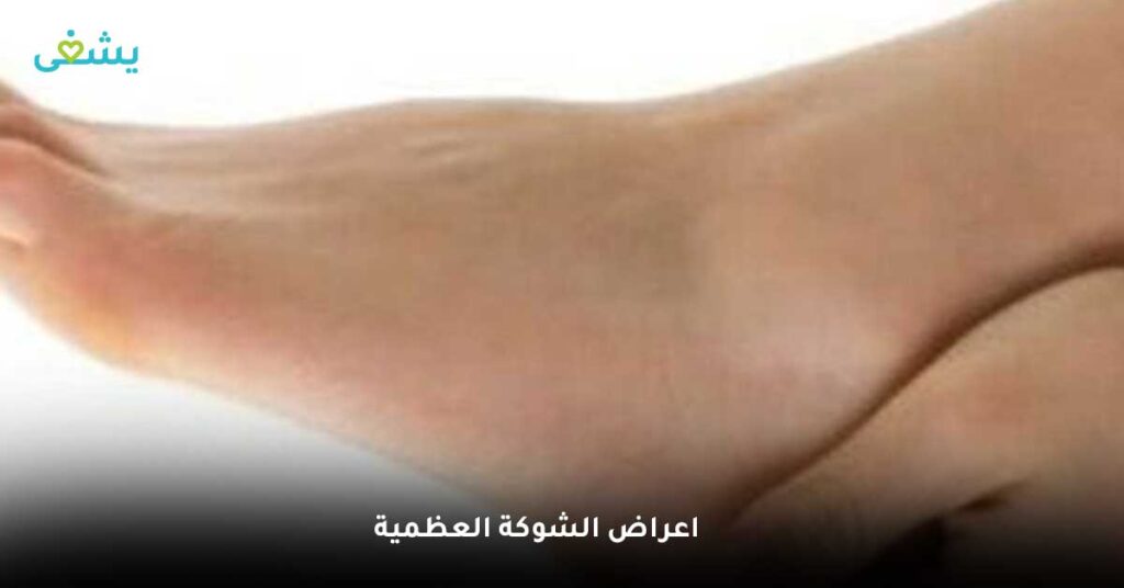 اعراض الشوكة العظمية