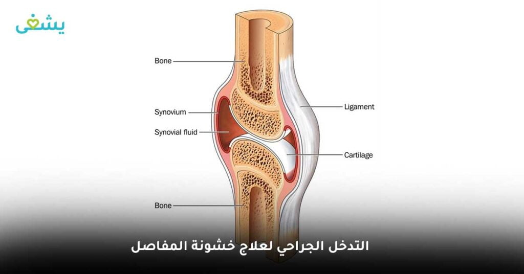 التدخل الجراحي لعلاج خشونة المفاصل