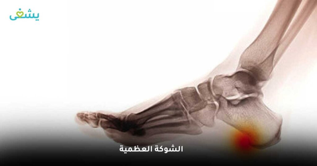 الشوكة العظمية