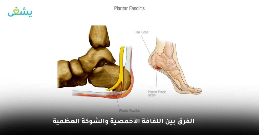 الفرق بين اللفافة الأخمصية والشوكة العظمية