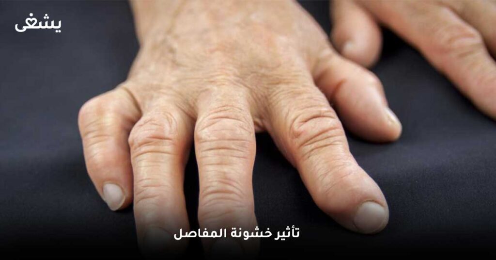 تأثير خشونة المفاصل