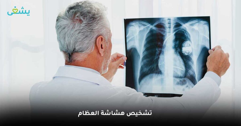 تشخيص هشاشة العظام