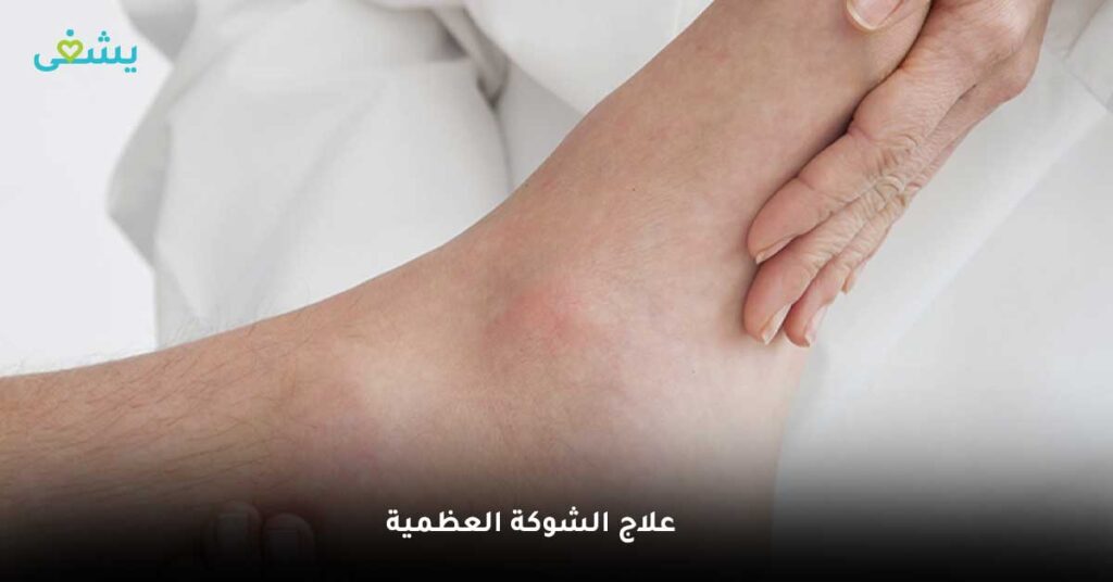 علاج الشوكة العظمية