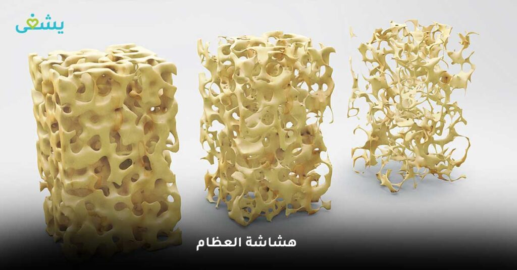 هشاشة العظام