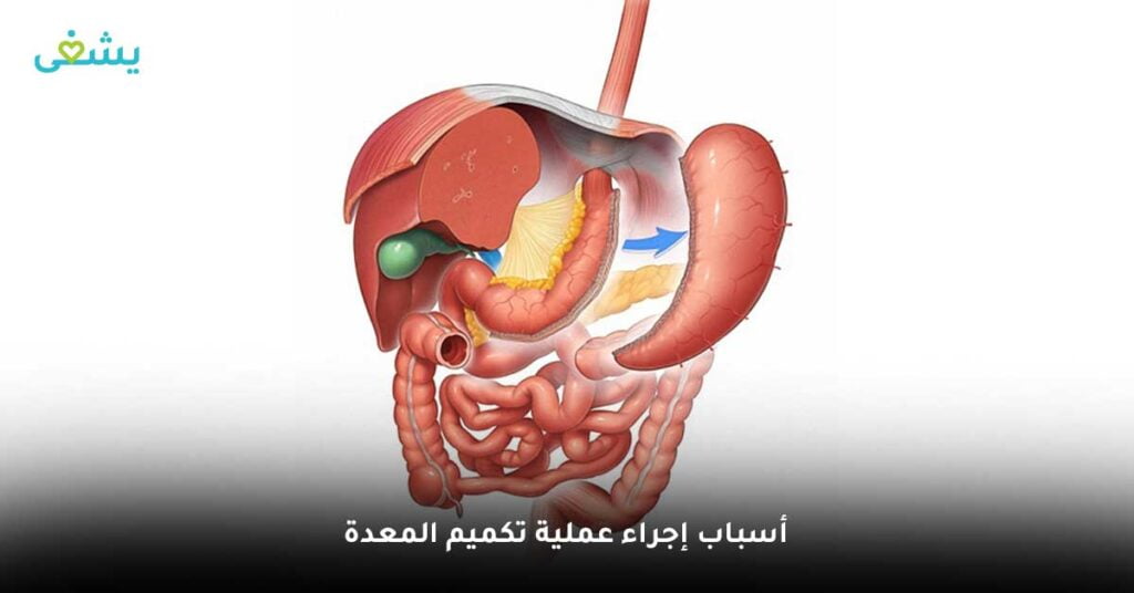 أسباب إجراء عملية تكميم المعدة
