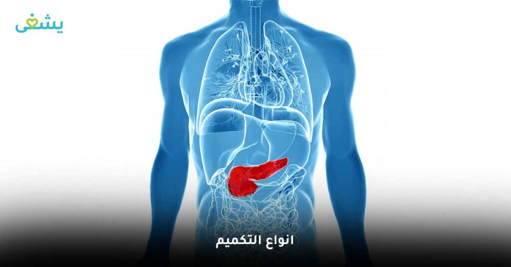 انواع التكميم