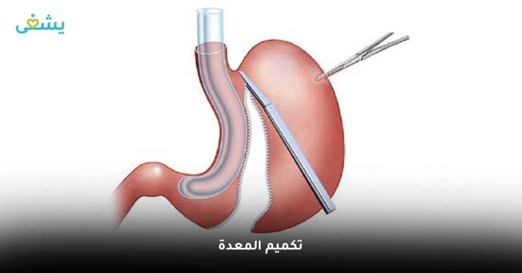 تكميم المعدة