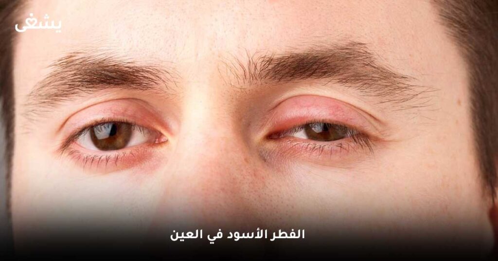 الفطر الأسود في العين