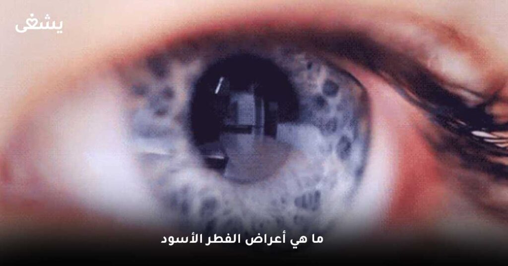 ما هي أعراض الفطر الأسود