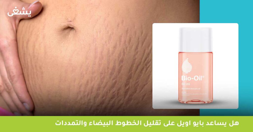 هل يساعد بايو اويل على تقليل الخطوط البيضاء والتمددات