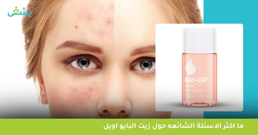 هل يساعد بايو اويل في علاج آثار حب الشباب