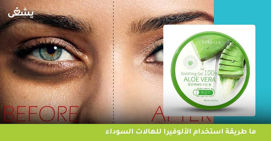 ما طريقة استخدام الألوفيرا للهالات السوداء