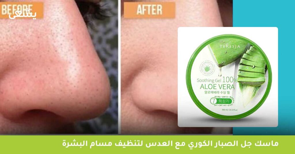 ماسك الصبار والعسل للوجه لبشرة خالية من البثور 